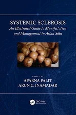 Systemic Sclerosis