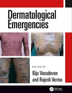 Dermatological Emergencies