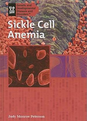 Sickle Cell Anemia