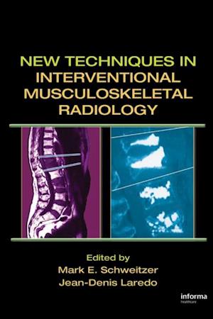 New Techniques in Interventional Musculoskeletal Radiology