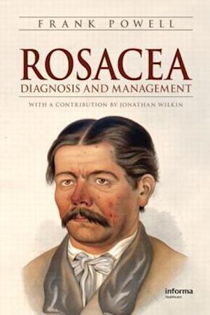 Rosacea