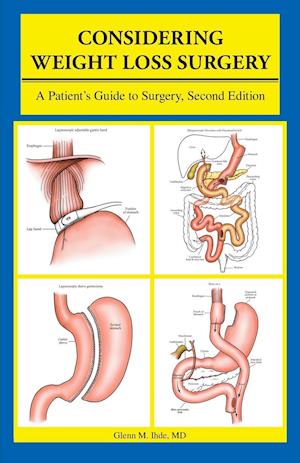 Considering Weight Loss Surgery