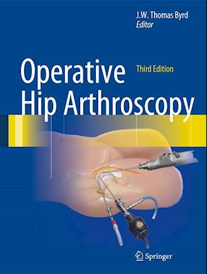 Operative Hip Arthroscopy