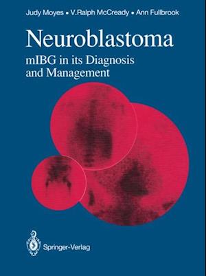 Neuroblastoma