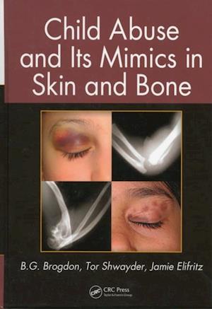 Child Abuse and its Mimics in Skin and Bone