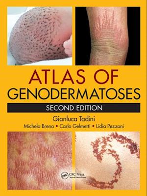 Atlas of Genodermatoses, Second Edition