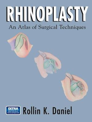 Rhinoplasty