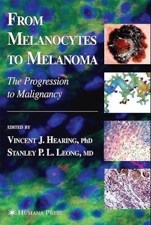 From Melanocytes to Melanoma