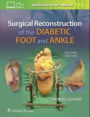 Surgical Reconstruction of the Diabetic Foot and Ankle