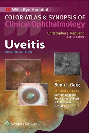 Uveitis