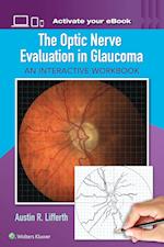 The Optic Nerve Evaluation in Glaucoma