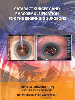 Cataract Surgery and Phacoemulsification for the Beginning   Surgeons