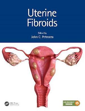 Uterine Fibroids