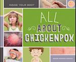 All about Chickenpox