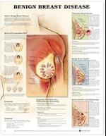 Benign Breast Disease Anatomical Chart