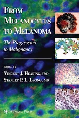 From Melanocytes to Melanoma