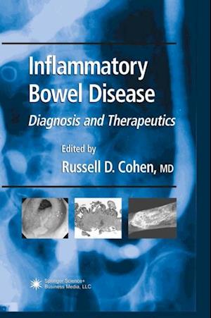 Inflammatory Bowel Disease