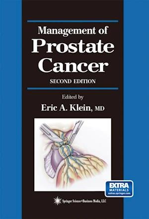 Management of Prostate Cancer