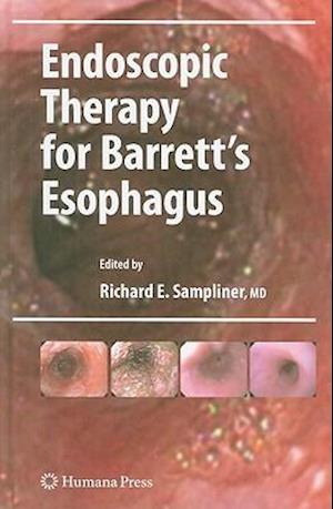 Endoscopic Therapy for Barrett's Esophagus