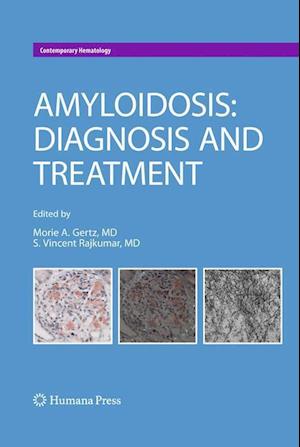 Amyloidosis