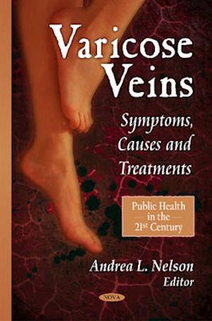 Varicose Veins