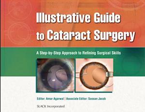 Illustrative Guide to Cataract Surgery