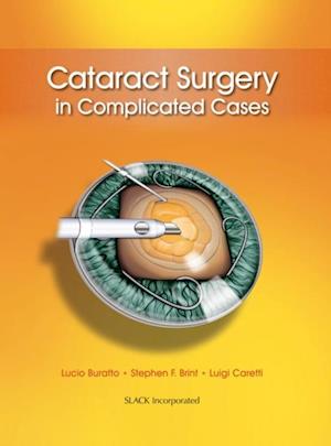 Cataract Surgery in Complicated Cases