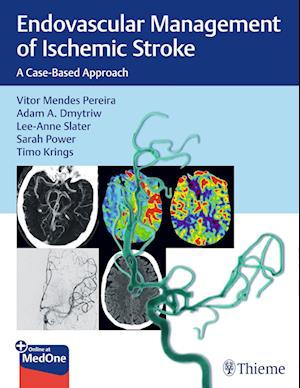 Endovascular Management of Ischemic Stroke: A Case-Based Approach