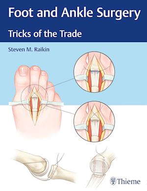 Foot and Ankle Surgery: Tricks of the Trade
