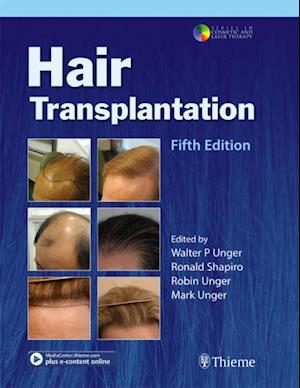 Hair Transplantation