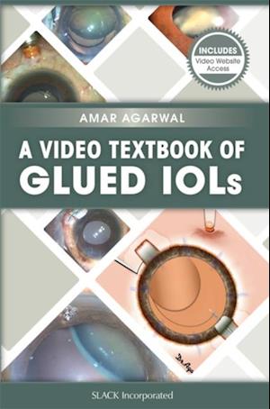 Video Textbook of Glued IOLs