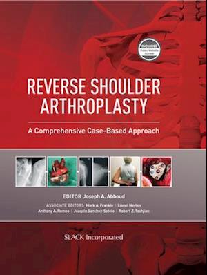 Reverse Shoulder Arthroplasty