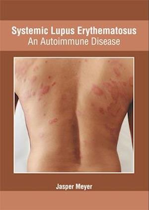 Systemic Lupus Erythematosus