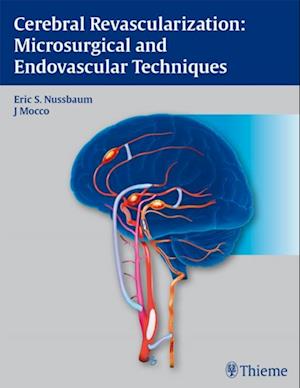 Cerebral Revascularization: Microsurgical and Endovascular Techniques