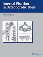 Internal Fixation in Osteoporotic Bone