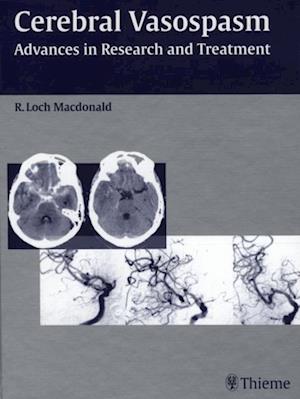 Cerebral Vasospasm