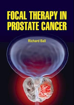 Få Focal Therapy In Prostate Cancer Af Richard Ball Som E-bog I EPub ...