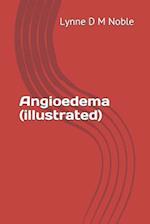 Angioedema (Illustrated)