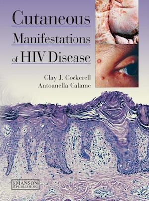 Cutaneous Manifestations of HIV Disease