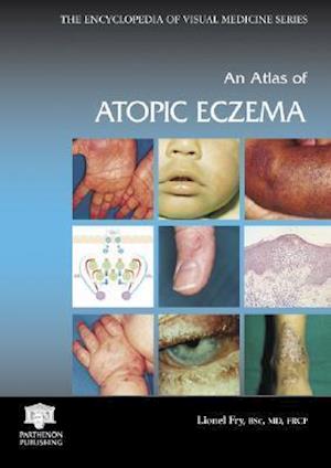 An Atlas of Atopic Eczema