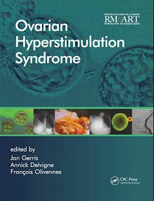 Ovarian Hyperstimulation Syndrome