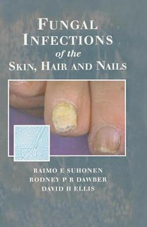 Fungal Infections of the Skin and Nails