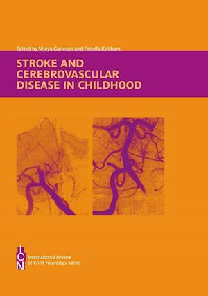 Stroke and Cerebrovascular Disease in Childhood