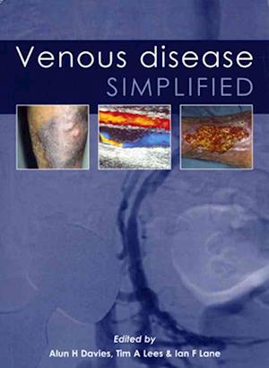 Venous Disease Simplified