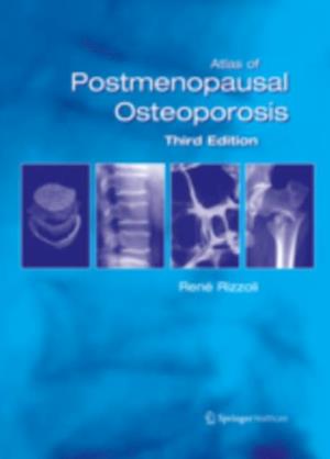 Atlas of Postmenopausal Osteoporosis