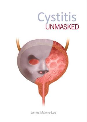 Cystitis unmasked