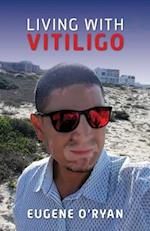 Living with Vitiligo 