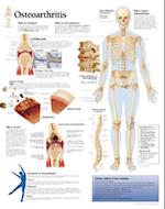 Understanding Osteoarthritis Chart