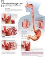 Understanding Gerd Chart