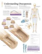 Understanding Osteoporosis Chart